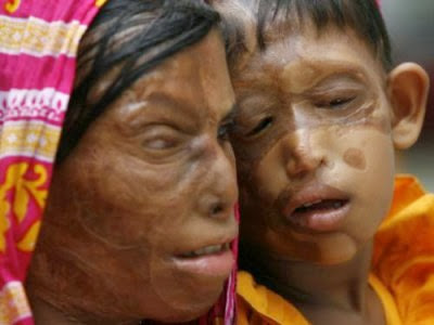 C:\Users\M B Nirmal\Desktop\Lavanya discuss\acid-burn-victims.jpg