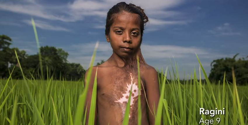 http://www.browngirlmagazine.com/wp-content/uploads/2015/06/Burned-Girl.jpg