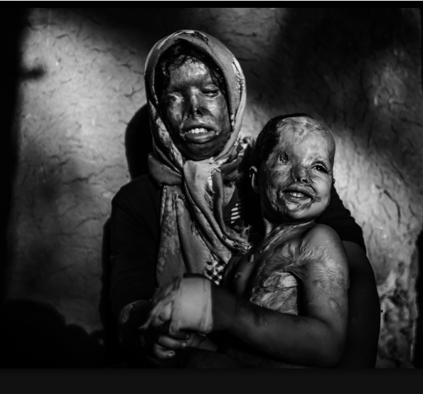 Image result for acid attack against children