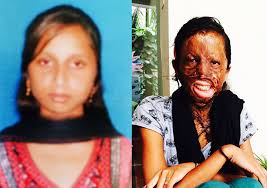 Image result for acid attack against women